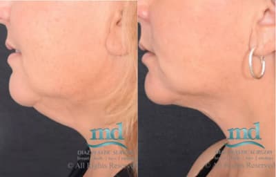 Dr. Michael Diaz Before and After Surgery Sample #3