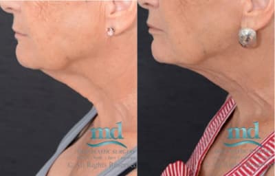 Dr. Michael Diaz Before and After Surgery Sample #4