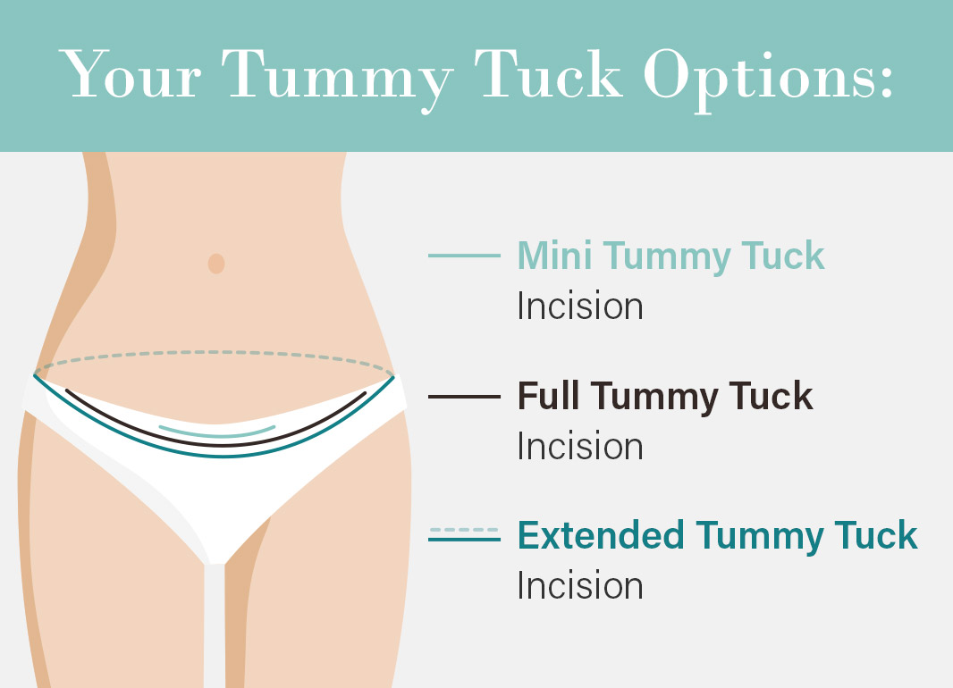 What's the difference between a fleur-de-lis and a standard tummy tuck? -  KCM Clinic